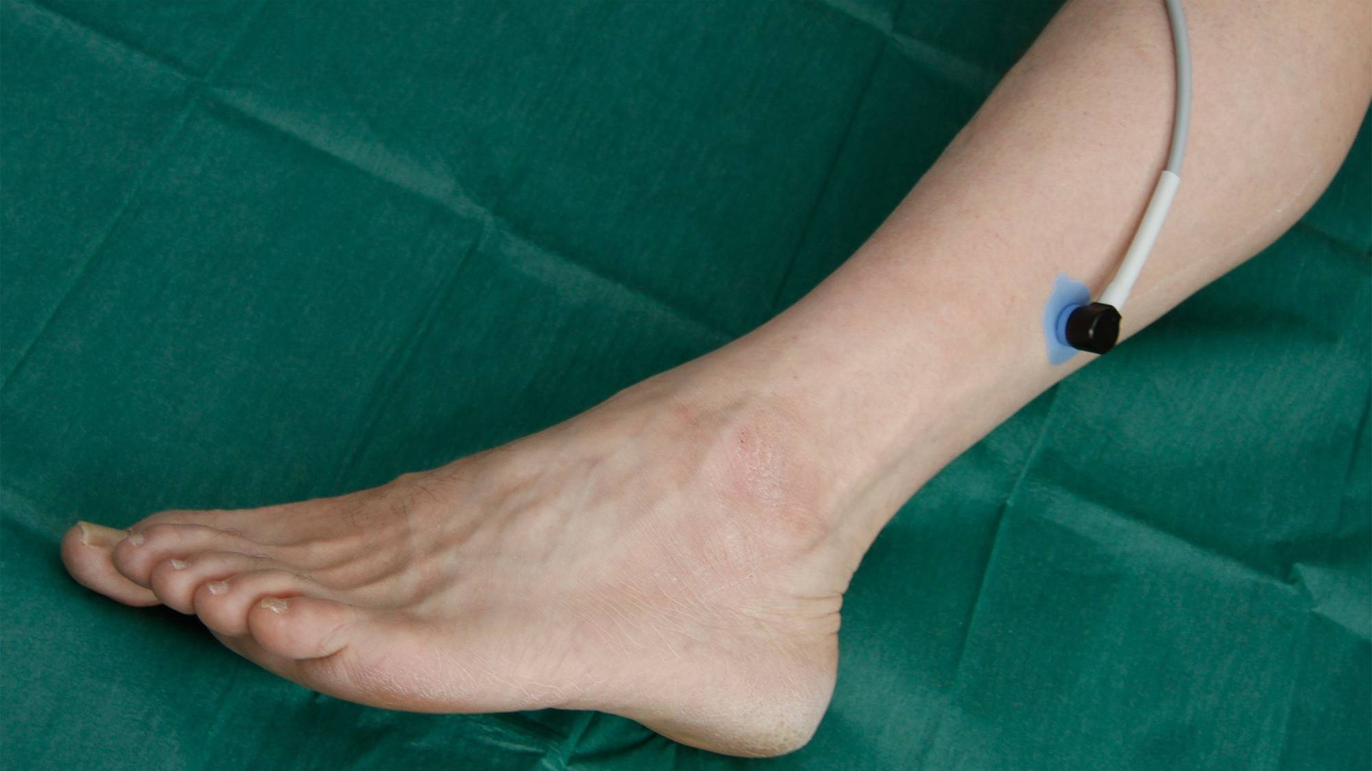 tcpo2 Messpunkt Wade